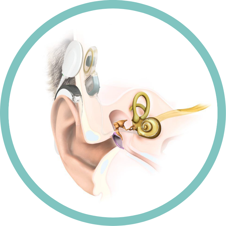 Cochlea Implantate